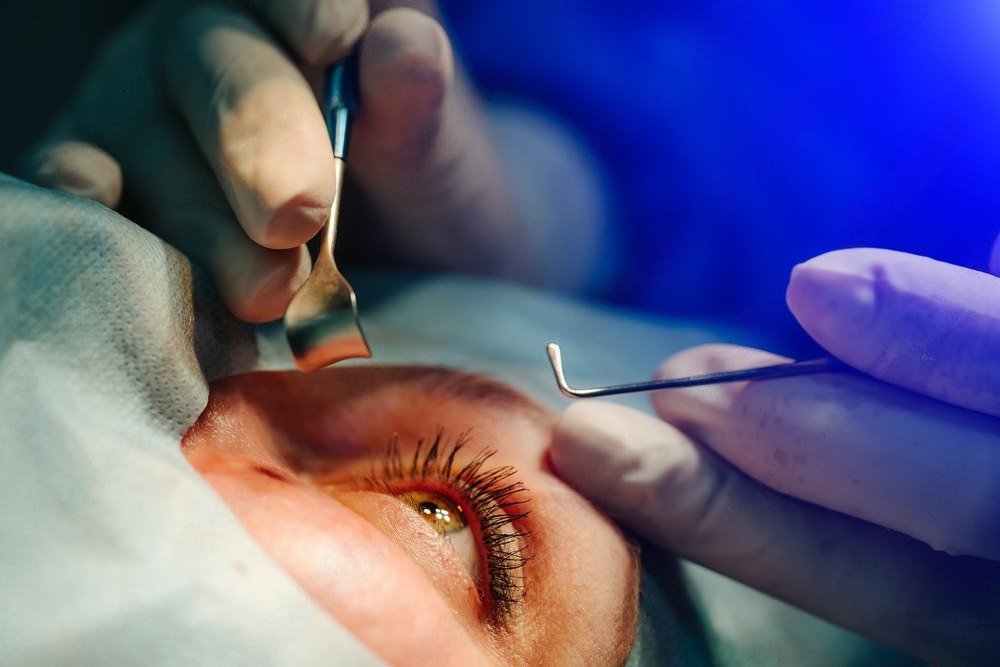 The Benefits of Early Cataract Surgery: Why You Shouldn’t Delay Treatment